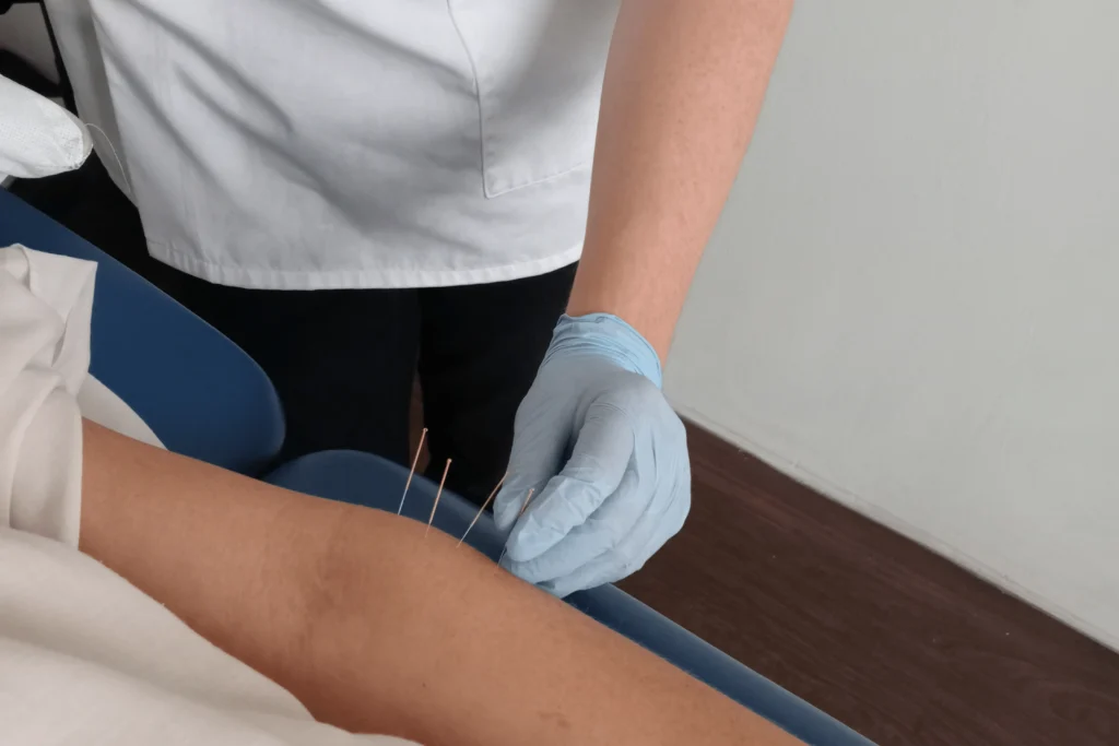 Acupuncture Bexley